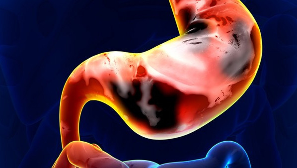 慢性胃出血的病因