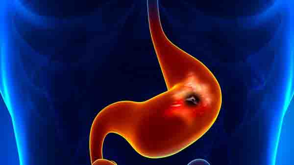 胃出血应该全面防治