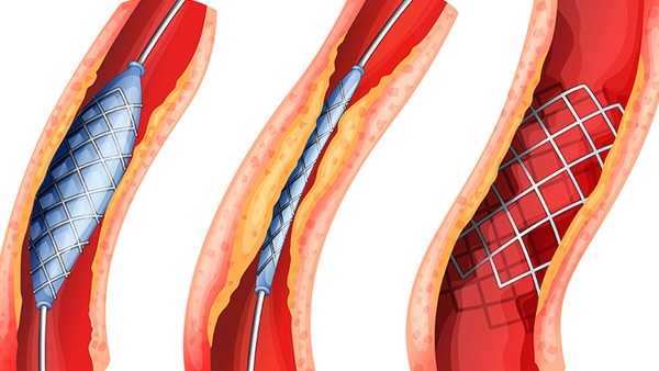 儿童怎么预防血管瘤