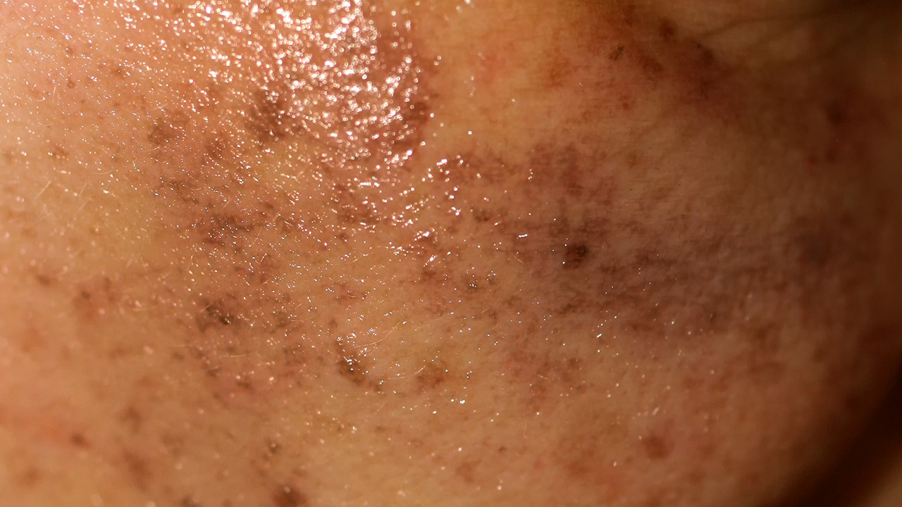 激光祛斑后出现反黑怎么办