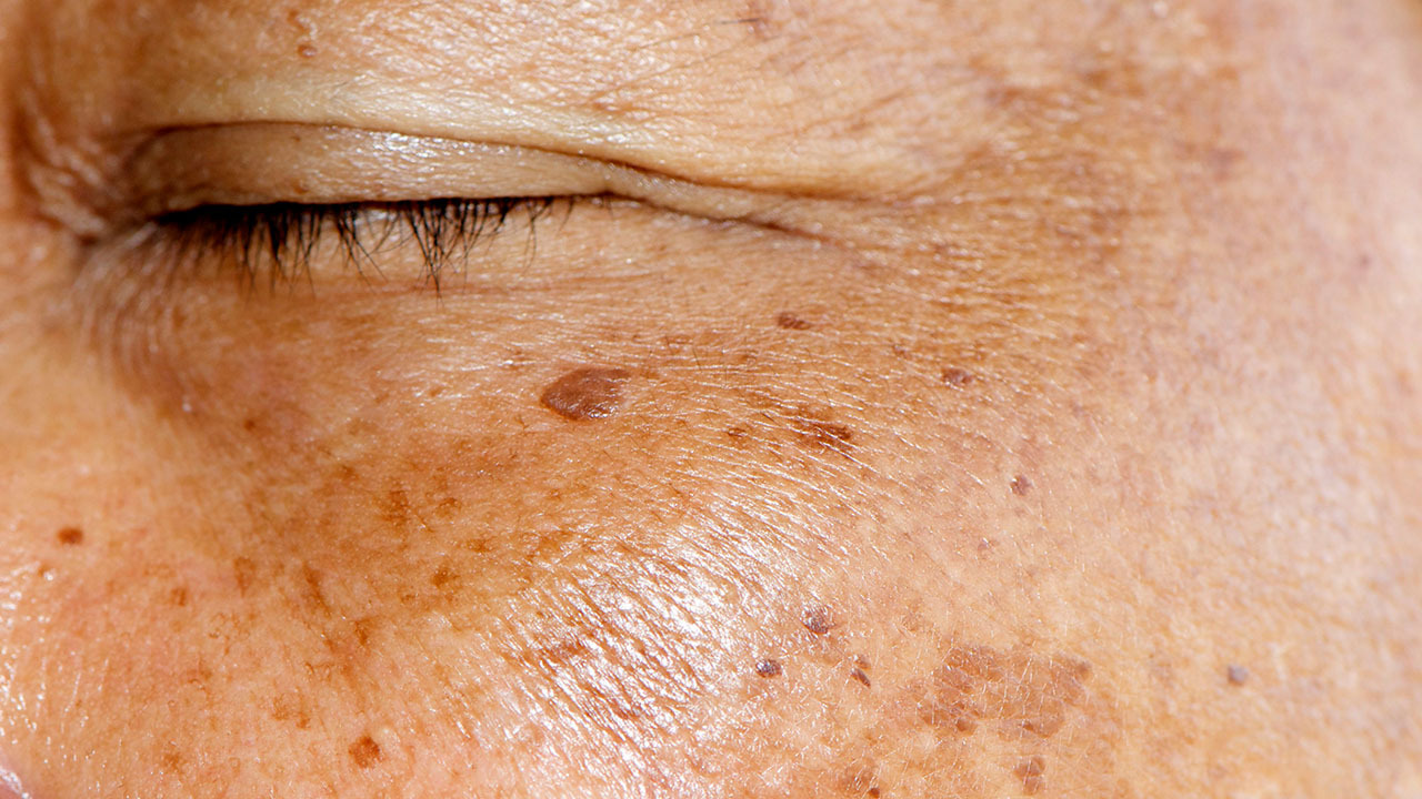 黄褐斑的形成原因