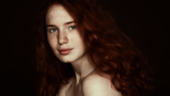 黄褐斑会复发吗