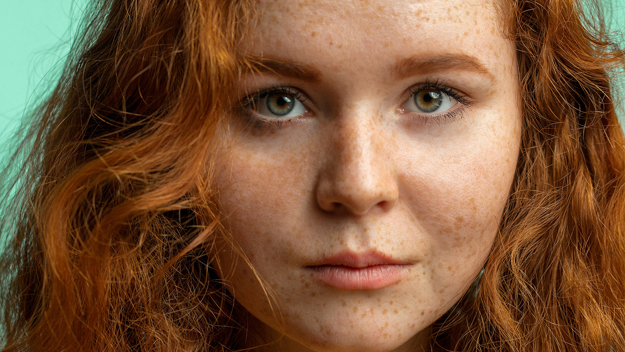 黄褐斑严重能治好吗