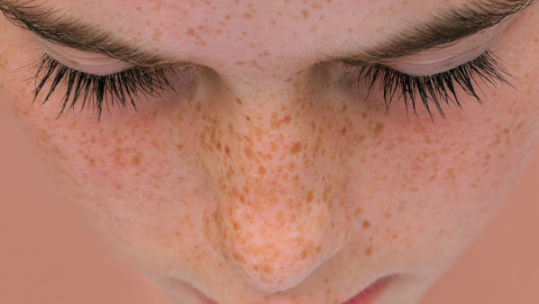 吃中药多久黄褐斑淡化