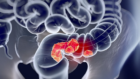 粘连性肠梗阻的早期症状有哪些