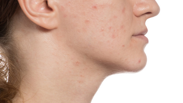 脸上长痤疮的原因有哪些