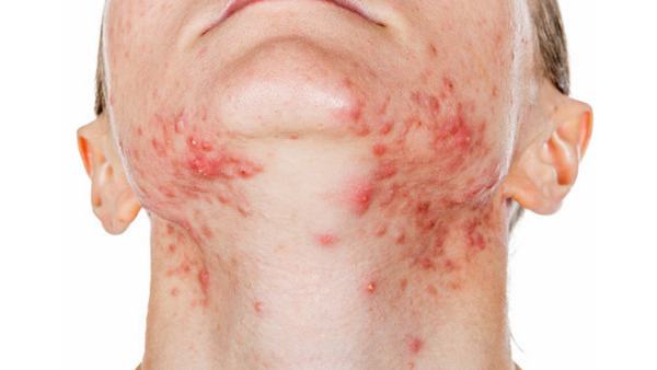 扁平疣可以吃什么药去除