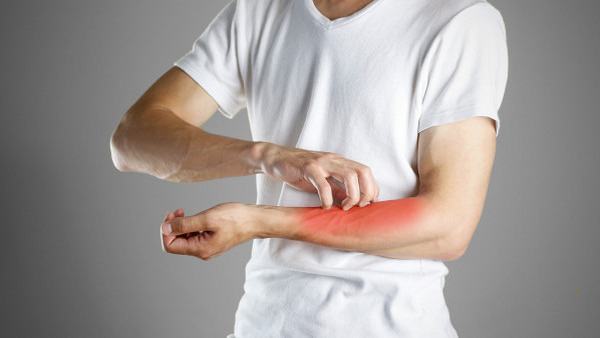 治疗过敏性皮炎的中药