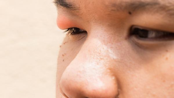 小孩扁平疣用什么药膏可以去除