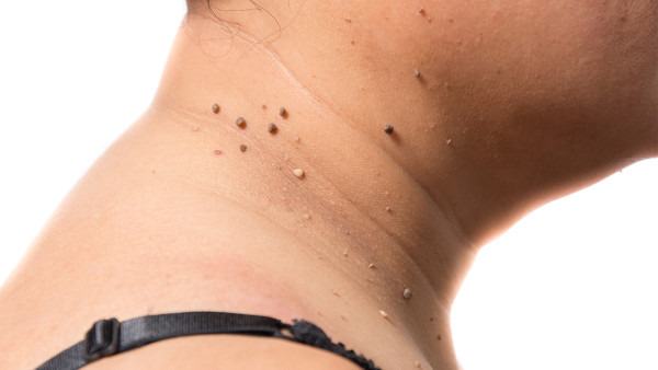 扁平疣吃什么药好的快