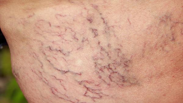 静脉曲张复发怎么判断