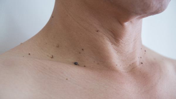 脸上长扁平疣是不是感染了hpv