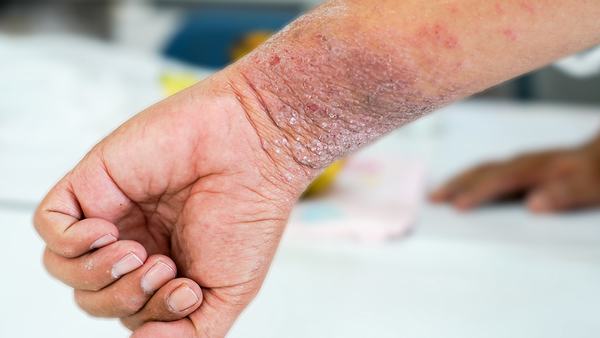 神经皮炎怎么治疗才能根治