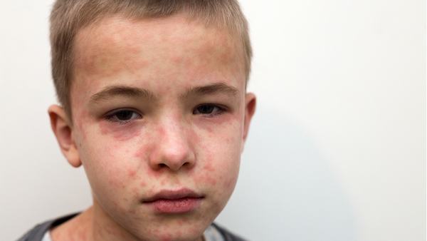 面部扁平疣用什么药膏除根