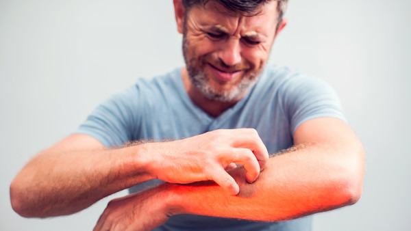 过敏性皮炎怎样根治