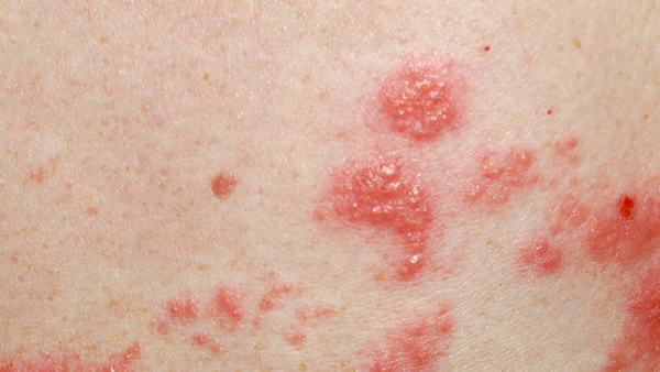 扁平疣越来越严重了怎么办