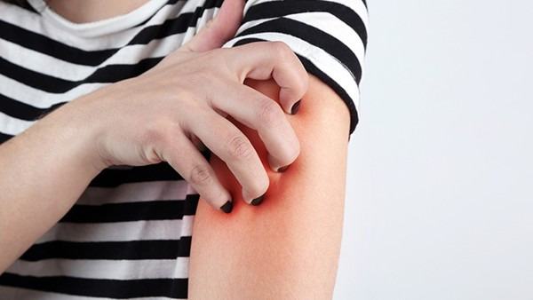 过敏性皮炎根治不了吗怎么治疗