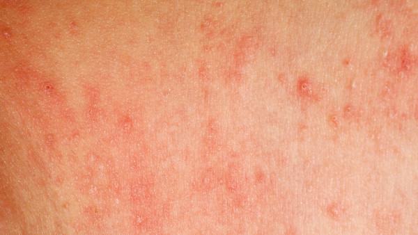 神经性皮炎是什么原因引起的