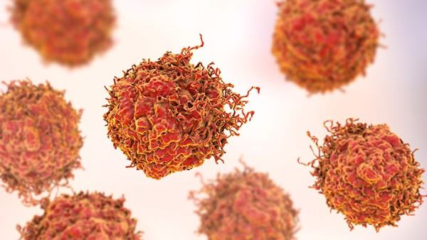 骨癌的前兆是什么症状怎么检查