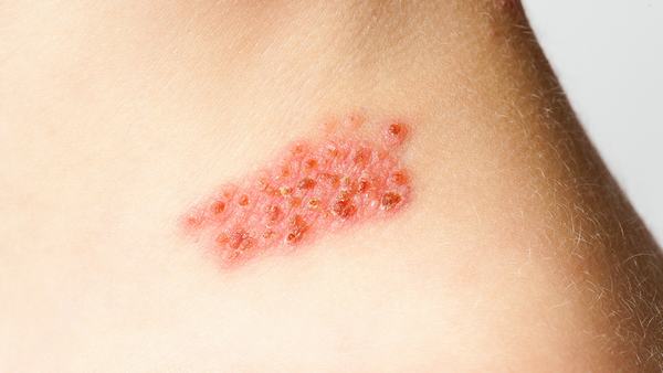 接触性皮炎症状