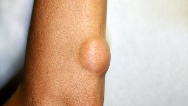 脊骨癌能治好吗