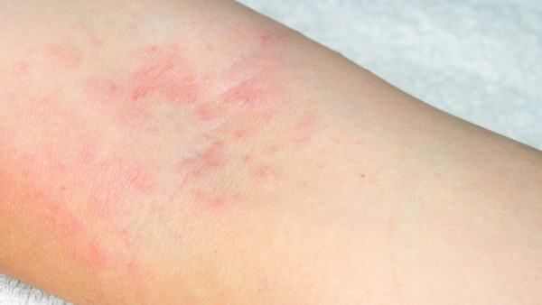 皮炎湿疹怎么办