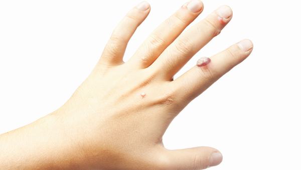 扁平疣怎么治疗根治