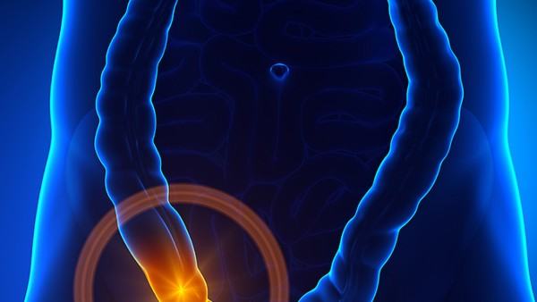 肛门息肉出血什么症状