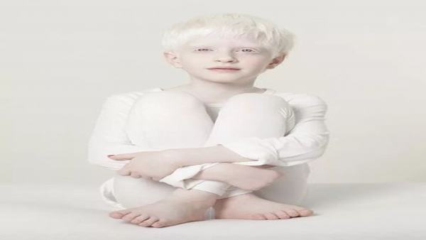 孩子是白化病怎么办