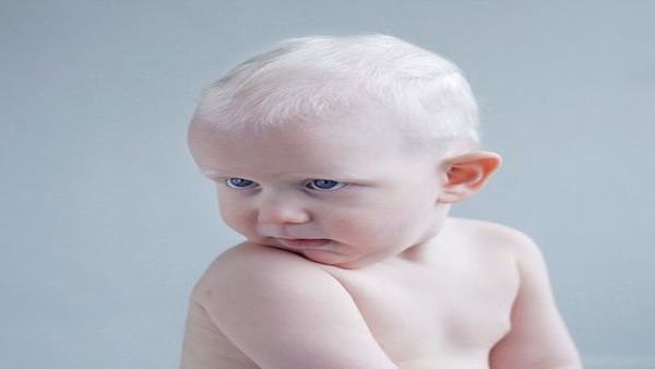 如何预防白化病的产生