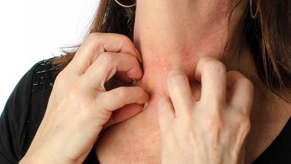 皮炎脸特别痒怎么办