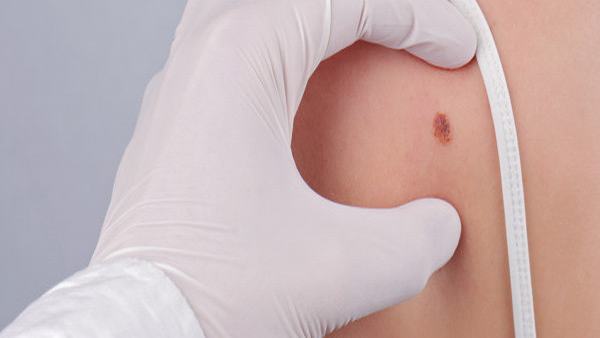 为什么要长蜘蛛痣