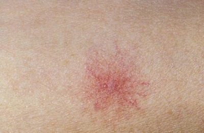 蜘蛛痣要多久形成恶变