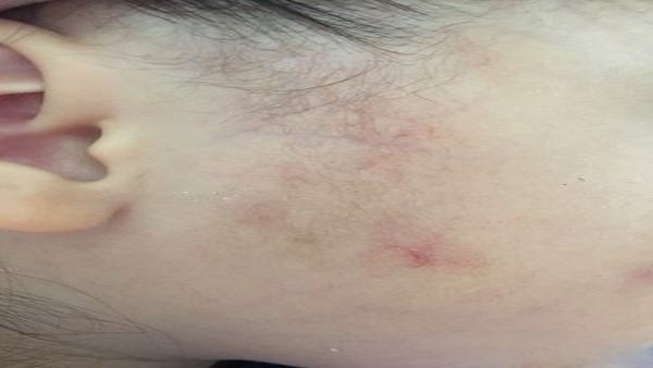 蜘蛛痣会长在哪些位置上