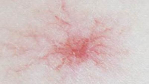 身体有哪些地方长了蜘蛛痣