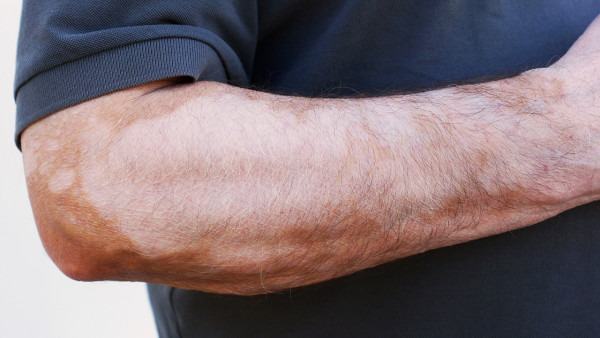 白癜风外用多久恢复