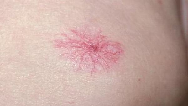 蜘蛛痣对孩子的危害有哪些