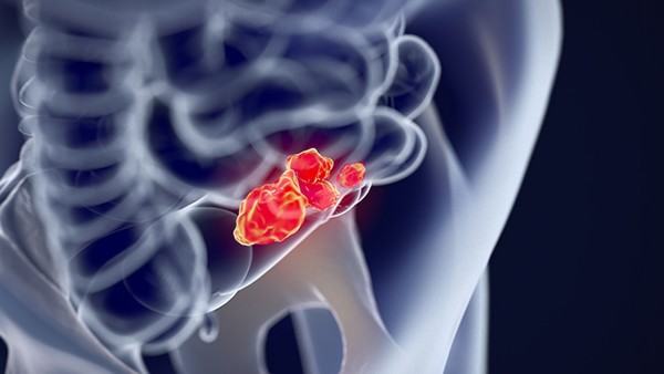 骨癌早期可以根治么