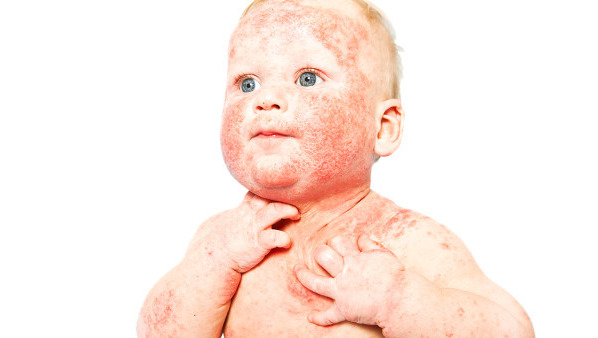 如何缓解荨麻疹的痒