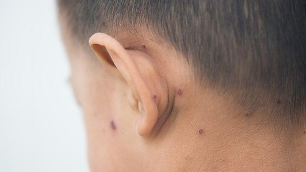 如何辨别是否是蜘蛛痣