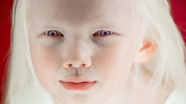 为什么近亲会得白化病