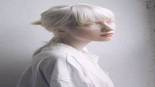 如何看出孩子是不是白化病