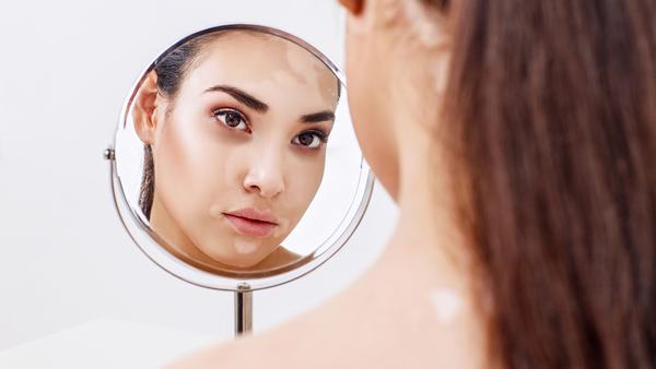 白癜风为什么容易复发