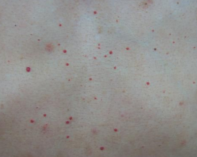 自己消除蜘蛛痣需要多久