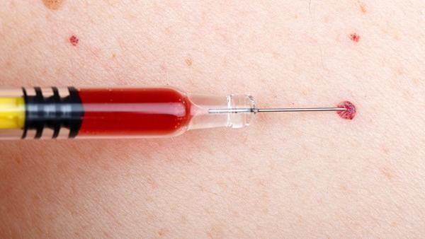 蜘蛛痣多见于下列哪些部位