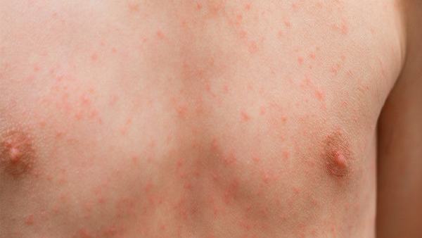 祛蜘蛛痣多久结痂好