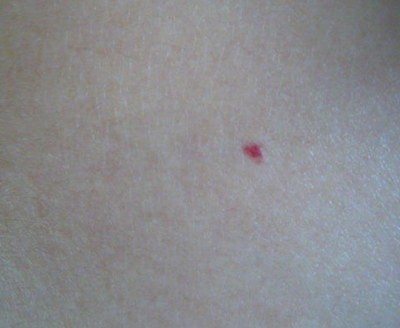 哪些病会长蜘蛛痣