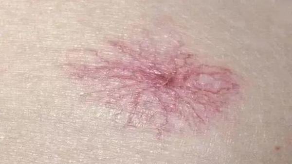 蜘蛛痣要多久形成的