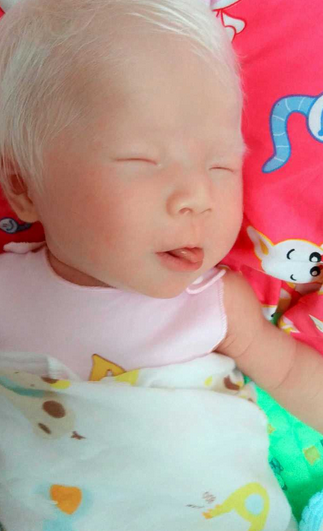 正常人怎么得白化病