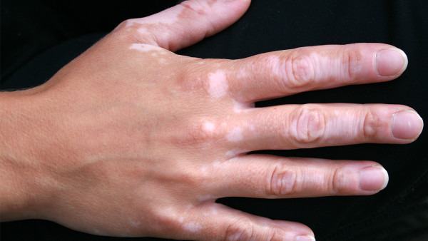 白癜风稳定期多久